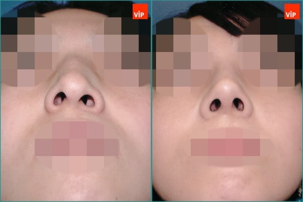 Nose Surgery - Septal cartilage rhinoplasty