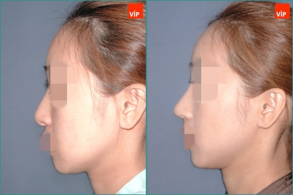 Nose Surgery - Septal cartilage rhinoplasty