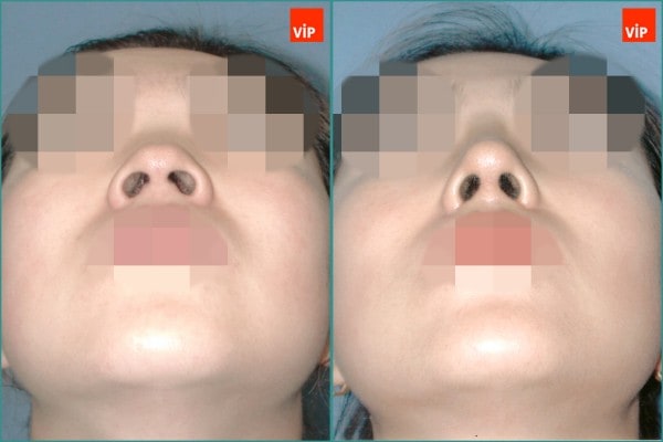 Nose Surgery - Septal cartilage rhinoplasty