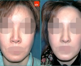 Contracted nose / Rib cartilage rhinoplasty