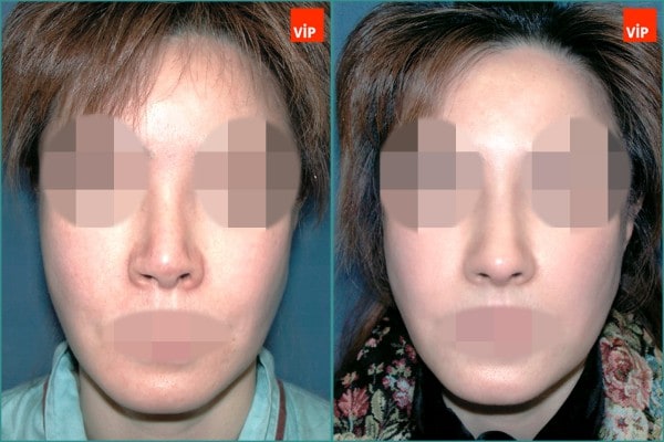 Nose Surgery - Contracted nose / Rib cartilage rhinoplasty