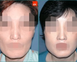 Rib cartilage rhinoplasty