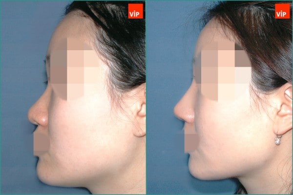 Nose Surgery - Septal cartilage rhinoplasty