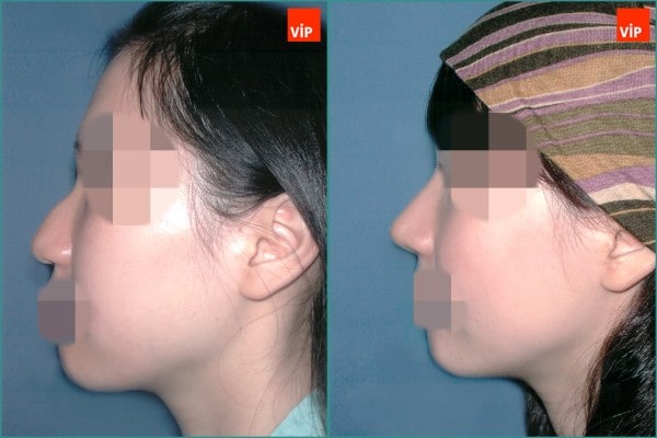 Nose Surgery - Hump nose