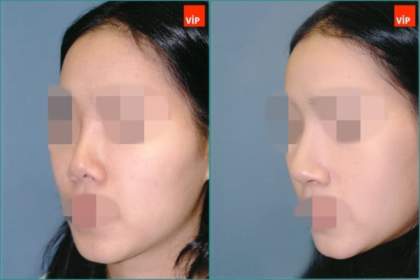 Nose Surgery - Septal cartilage rhinoplasty