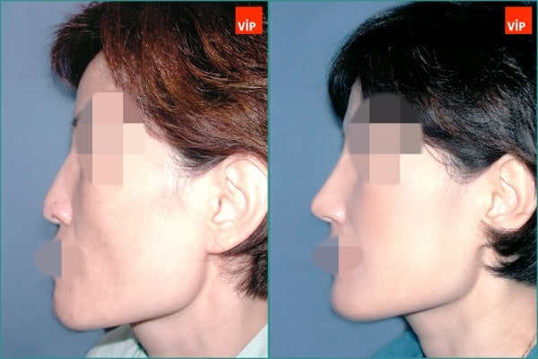 Nose Surgery - Rib cartilage rhinoplasty