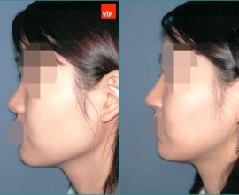 Septal cartilage rhinoplasty