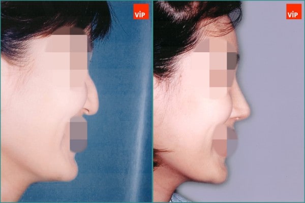 Nose Surgery - Hump nose