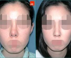Contracted nose / Rib cartilage rhinoplasty