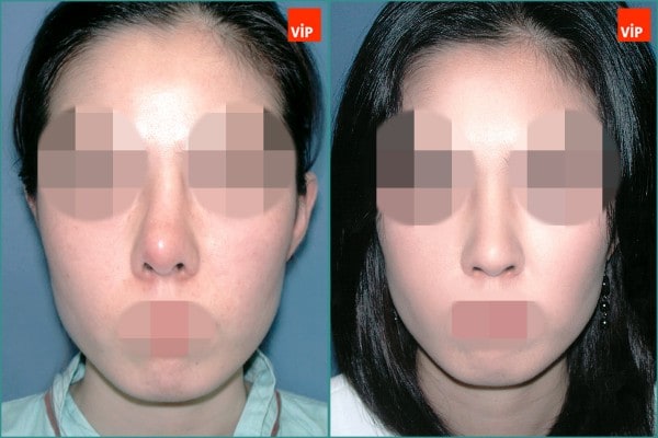 Nose Surgery - Contracted nose / Rib cartilage rhinoplasty