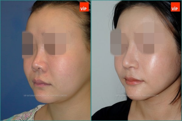 Nose Surgery - Rib cartilage rhinoplasty, Mid face augmentation