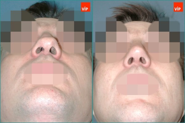 Nose Surgery - Septal cartilage rhinoplasty