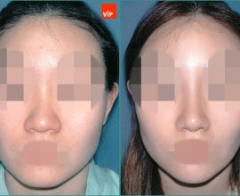 Septal cartilage rhinoplasty