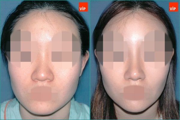 Nose Surgery - Septal cartilage rhinoplasty