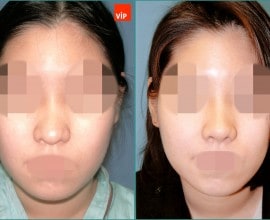 Septal cartilage rhinoplasty