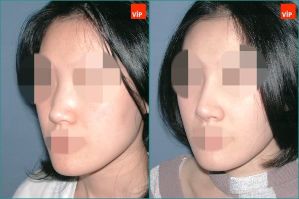 Nose Surgery - Septal cartilage rhinoplasty