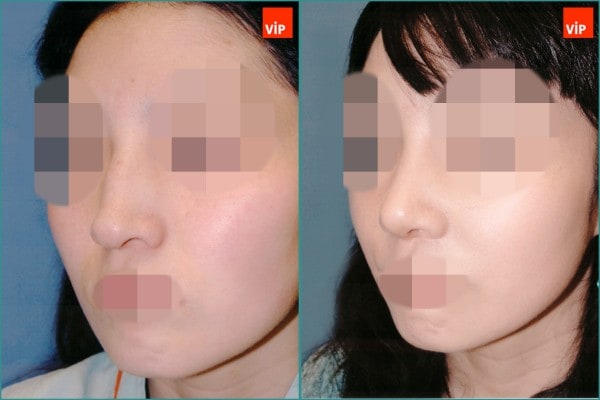 Nose Surgery - Septal cartilage rhinoplasty