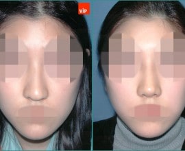 Septal cartilage rhinoplasty