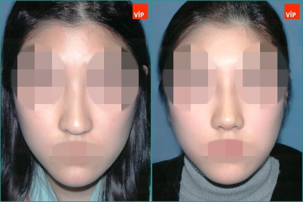 Nose Surgery - Septal cartilage rhinoplasty