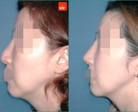 Septal cartilage rhinoplasty