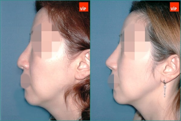 Nose Surgery - Septal cartilage rhinoplasty