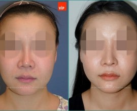 Rib cartilage rhinoplasty, Mid face augmentation