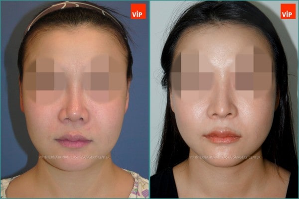 Nose Surgery - Rib cartilage rhinoplasty, Mid face augmentation