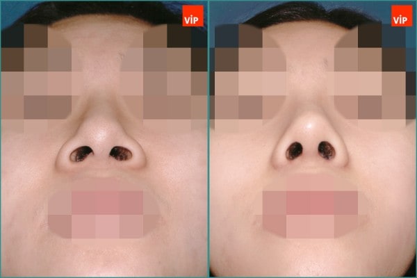 Nose Surgery - Septal cartilage rhinoplasty