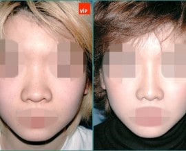 Septal cartilage rhinoplasty