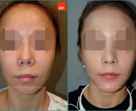 Rib cartilage rhinoplasty