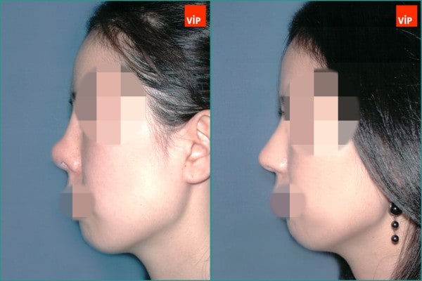 Nose Surgery - Contracted nose / Rib cartilage rhinoplasty