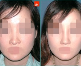 Septal cartilage rhinoplasty