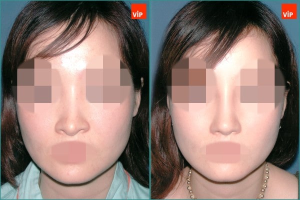 Nose Surgery - Septal cartilage rhinoplasty