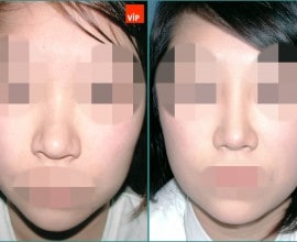 Septal cartilage rhinoplasty