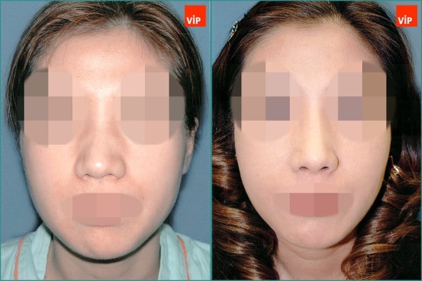 Nose Surgery - Septal cartilage rhinoplasty