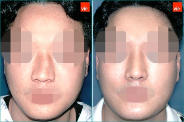 Nose Surgery - Deviated nose