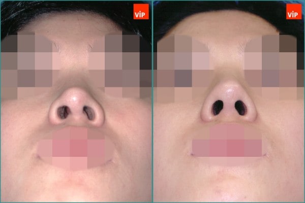 Nose Surgery - Septal cartilage rhinoplasty