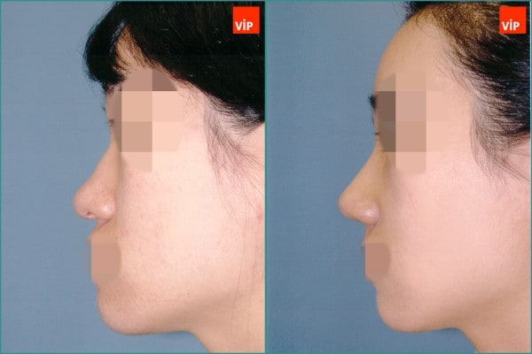 Nose Surgery - Septal cartilage rhinoplasty