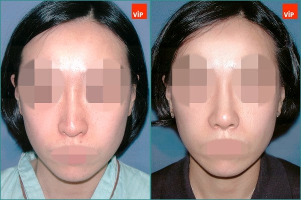 Nose Surgery - Septal cartilage rhinoplasty