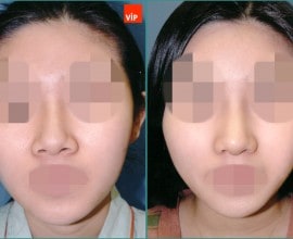 Septal cartilage rhinoplasty