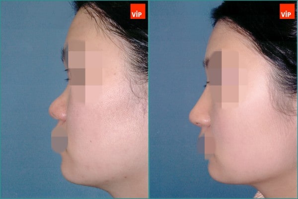 Nose Surgery - Septal cartilage rhinoplasty