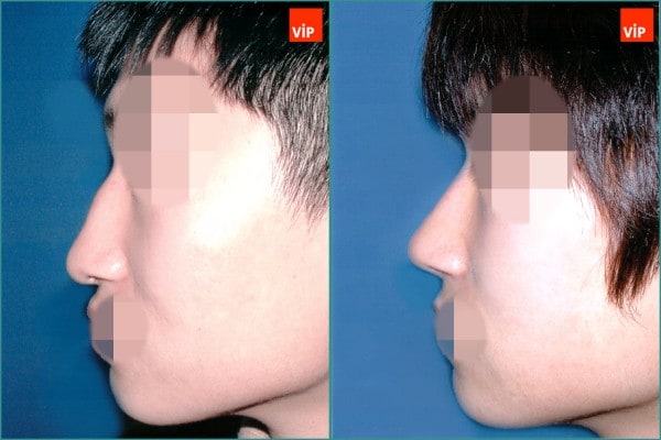 Nose Surgery - Droopy nose