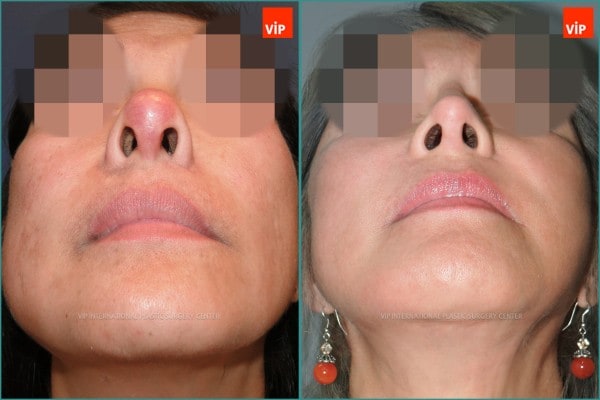 Nose Surgery - Face lift / Revision rhinoplasty / Rib cartilage rhinoplasty