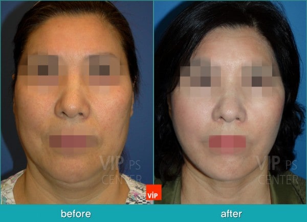 Face Lift - High SMAS Face / Necklift