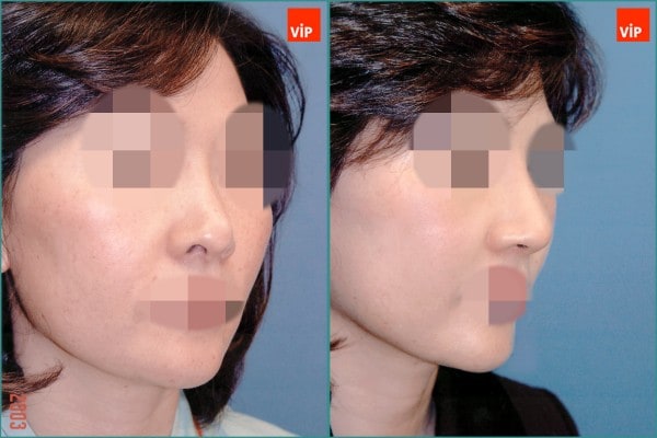 Nose Surgery - Septal cartilage rhinoplasty