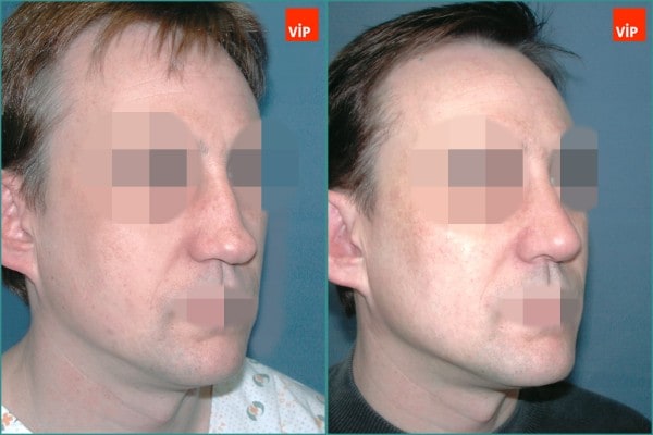 Nose Surgery - Septal cartilage rhinoplasty