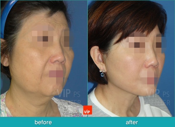 Face Lift - High SMAS Face / Necklift