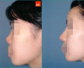 Rib cartilage rhinoplasty