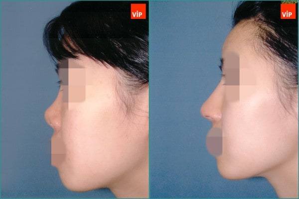 Nose Surgery - Rib cartilage rhinoplasty