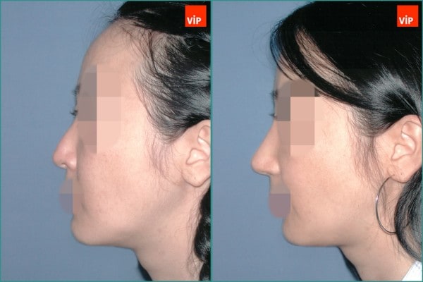 Nose Surgery - Septal cartilage rhinoplasty